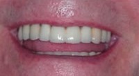Полное восстановление зубного ряда с помощью имплантатов