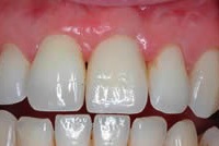 Восстановление утраченного зуба с помощью имплантата