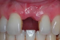 Восстановление утраченного зуба с помощью имплантата